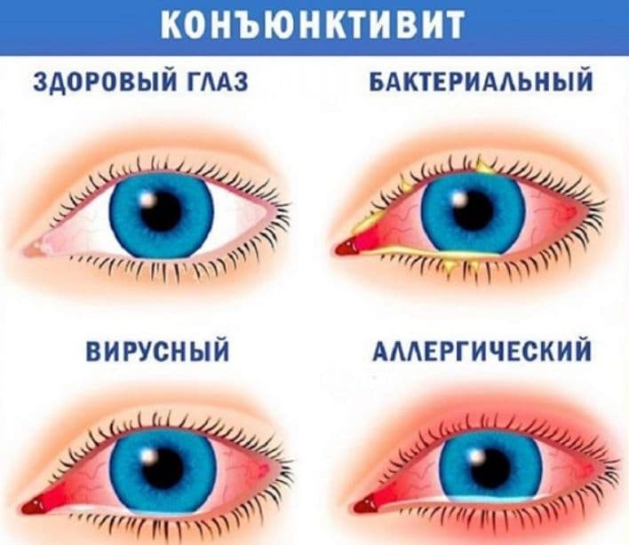 Конъюнктивит: первые симптомы, виды и первая помощь при воспалении глаз.